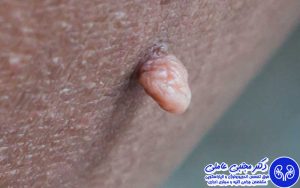 خال و زائده پوستی ناحیه تناسلی