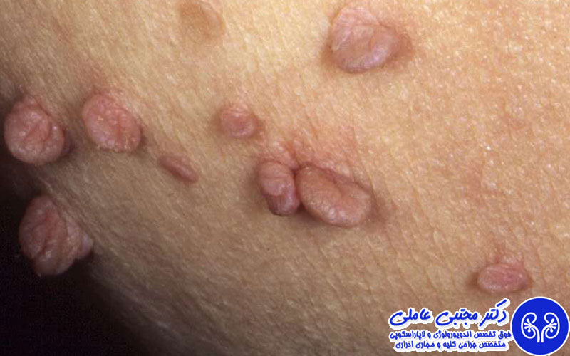 خال و زائده پوستی ناحیه تناسلی