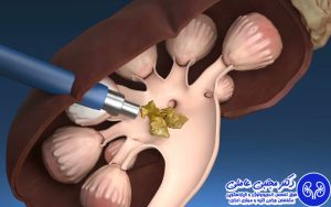 درمان سنگ کلیه با روش بسته PCNL