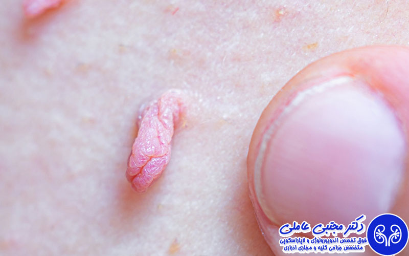 آیا با وجود زگیل تناسلی میتوان واکسن گارداسیل زد