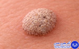 راهکارهای پیشگیری از زگیل تناسلی