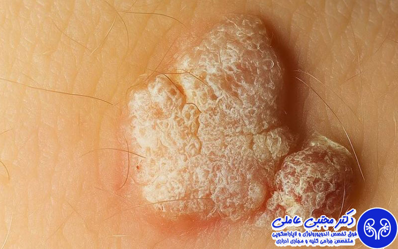 اقدامات اشتباه بعد از مشاهده ضایعه در ناحیه تناسلی
