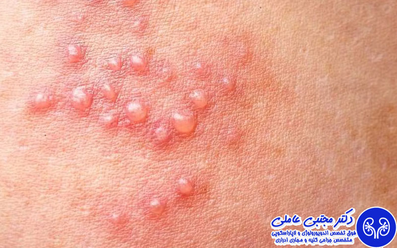 اقدامات اشتباه بعد از مشاهده ضایعه در ناحیه تناسلی