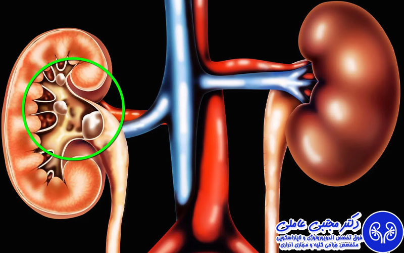 ۷ گروهی که بیشتر مستعد سنگ کلیه هستند