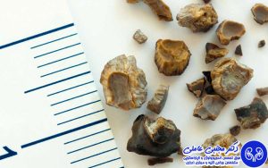 انواع سنگ کلیه