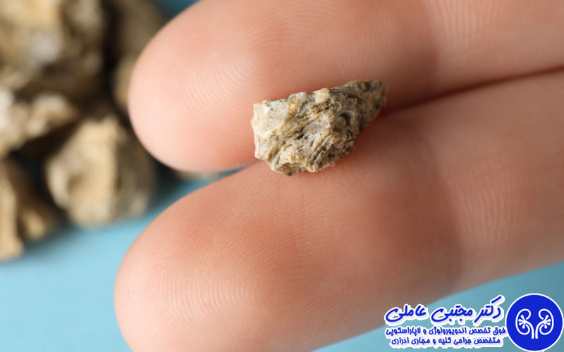 انواع سنگ کلیه