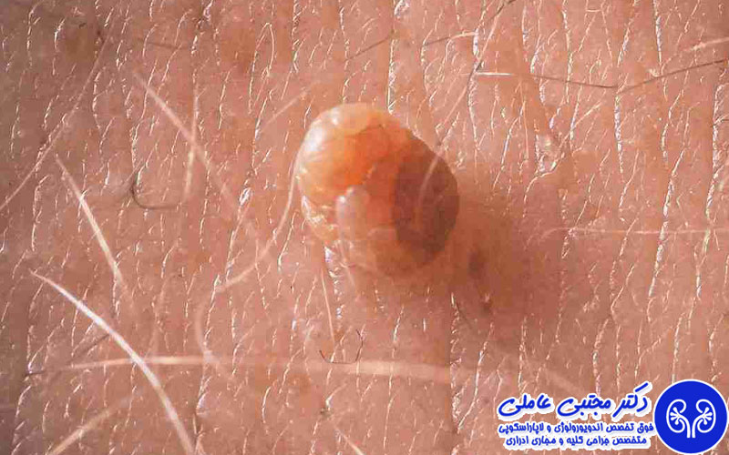 دلیل برگشت زگیل تناسلی