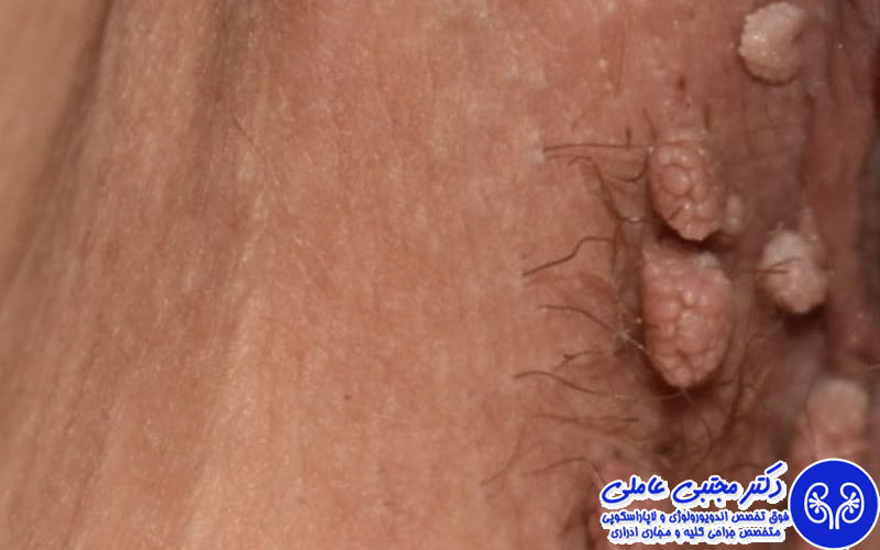 سوال های ضروری قبل از شروع درمان زگیل تناسلی