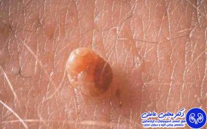 سوال های ضروری قبل از شروع درمان زگیل تناسلی