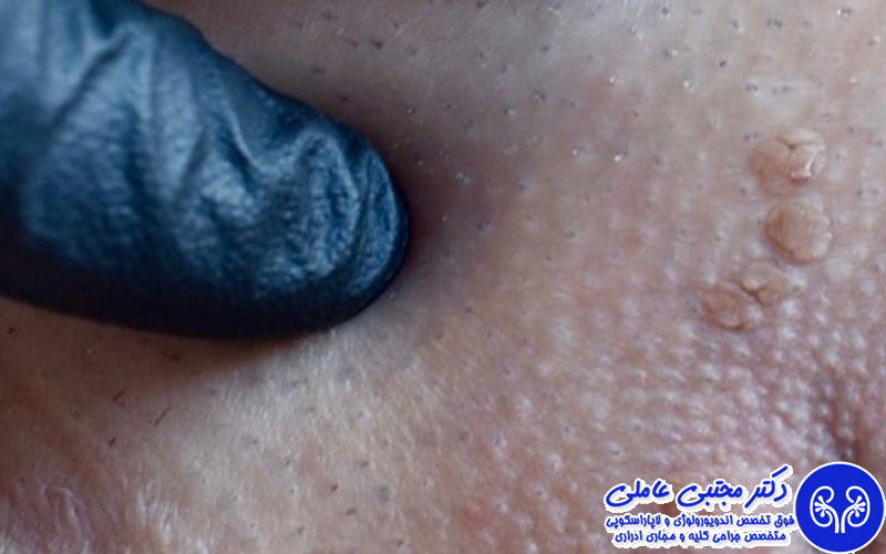 سوال های ضروری قبل از شروع درمان زگیل تناسلی