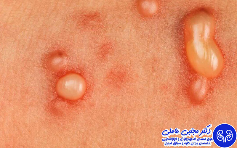 عوامل مؤثر بر HPV و زگیل تناسلی