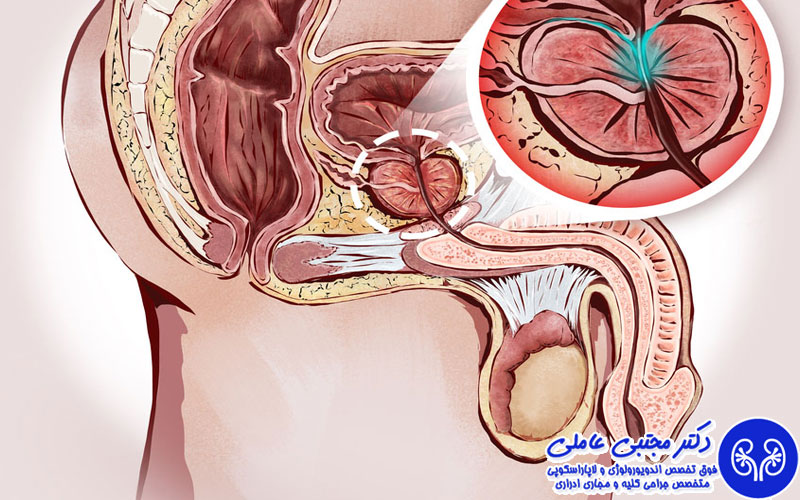 جراحی باز پروستات یا  HoLEP