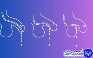علائم، انواع و درمان هیپوسپادیاس